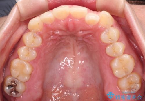 【モニター】カリエール・ディスタライザーを併用した八重歯のインビザライン矯正 の治療前