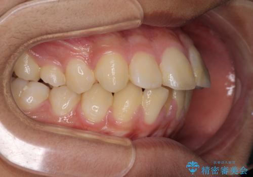 膨らんだ口元 ワイヤー装置での抜歯矯正の治療前