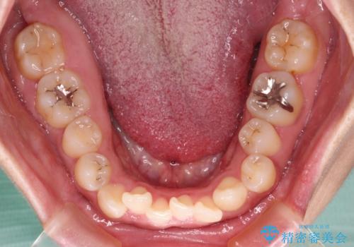 【モニター】カリエール・ディスタライザーを併用した八重歯のインビザライン矯正　の治療前