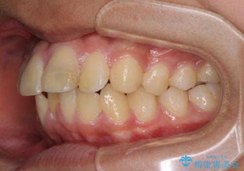 膨らんだ口元 ワイヤー装置での抜歯矯正の治療前