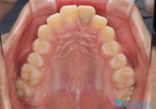膨らんだ口元 ワイヤー装置での抜歯矯正の治療前