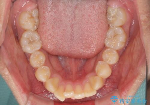 膨らんだ口元 ワイヤー装置での抜歯矯正の治療前