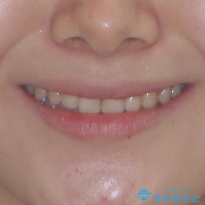 治療途中の奥歯と矯正治療の後戻り　インビザライン・ライトによる矯正治療の治療後（顔貌）