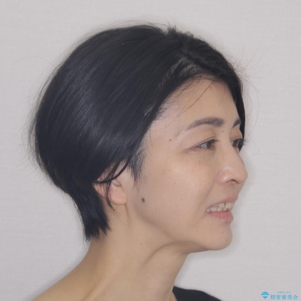 【モニター】飛び出た前歯を整えたい ワイヤー矯正治療の治療前(顔貌)
