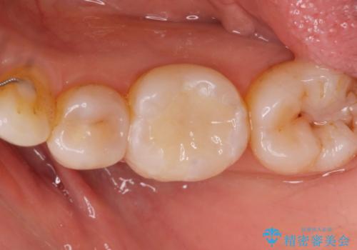 e-maxインレー治療の治療後