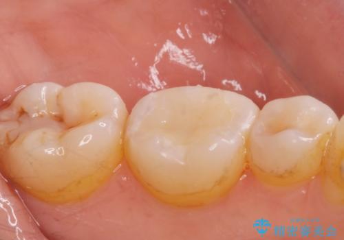 e-maxインレー治療の治療後