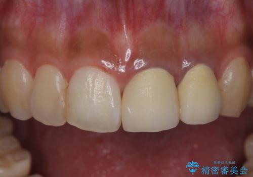 前歯の歯茎の黒ずみと被せ物の形と色が気になる【オールセラミッククラウン】の治療前