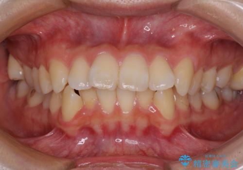 【モニター】口が閉じにくい　抜歯矯正で口元を引っ込めるの症例 治療前