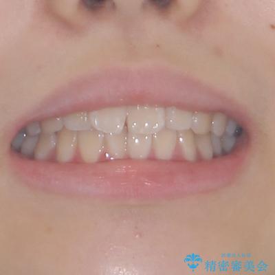 インビザラインは使える自信がない ワイヤー装置にて矯正治療の治療前(顔貌)