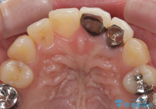 前歯の歯茎の黒ずみと被せ物の形と色が気になる【オールセラミッククラウン】の治療前