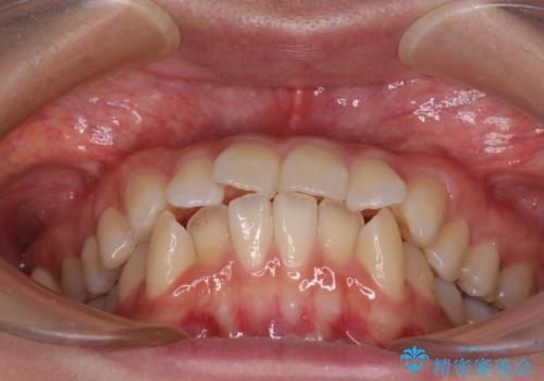 【モニター】口が閉じにくい　抜歯矯正で口元を引っ込めるの治療前