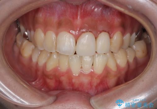 前歯の歯茎の黒ずみと被せ物の形と色が気になる【オールセラミッククラウン】の治療中