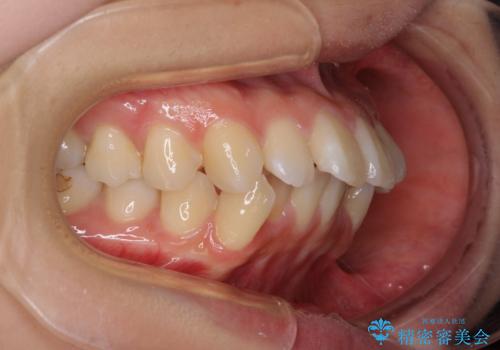 【モニター】口が閉じにくい 抜歯矯正で口元を引っ込めるの治療前