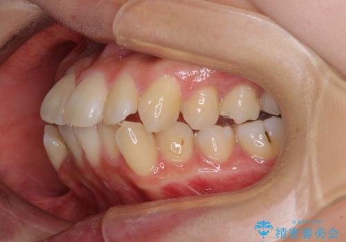 【モニター】口が閉じにくい 抜歯矯正で口元を引っ込めるの治療前