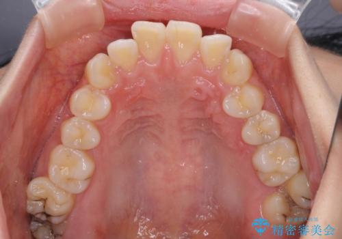 【モニター】口が閉じにくい 抜歯矯正で口元を引っ込めるの治療前