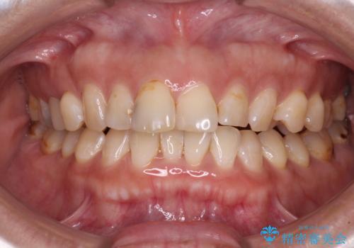 【モニター】飛び出た前歯を整えたい ワイヤー矯正治療の症例 治療前