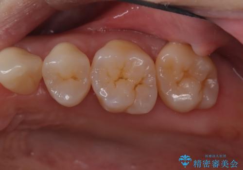 歯周病治療【オープンフラップ】の治療後