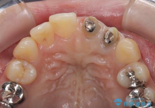 前歯の歯茎の黒ずみと被せ物の形と色が気になる【オールセラミッククラウン】の治療前