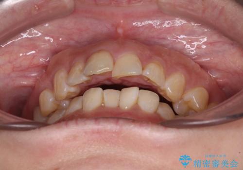 【モニター】飛び出た前歯を整えたい ワイヤー矯正治療の治療前