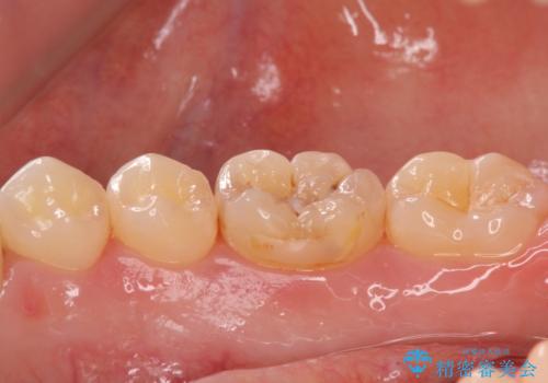 矯正後の虫歯治療 セラミックインレーでの治療の治療前
