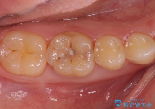 矯正後の虫歯治療　セラミックインレーでの治療の症例 治療前