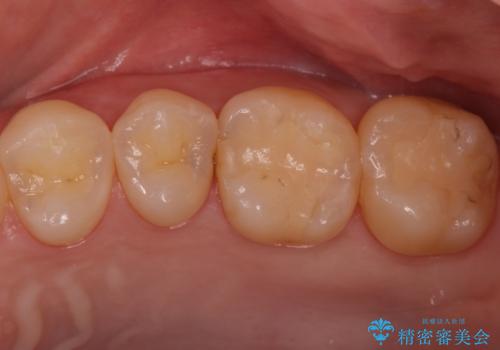 歯と歯の間の虫歯　セラミックインレーでの治療の症例 治療前