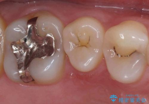 銀歯を白くしたい　セラミックインレーでの治療の症例 治療前
