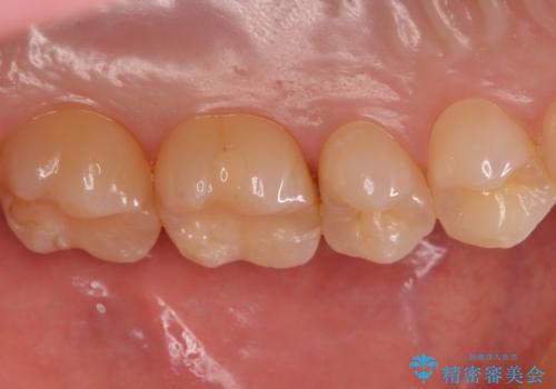 歯と歯の間の虫歯 セラミックインレーでの治療の治療前