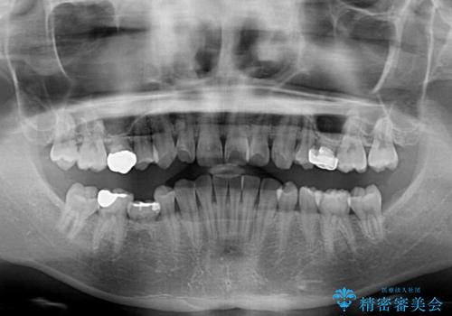インビザラインによる矯正治療と奥歯のインプラント治療の治療前