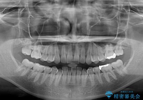 【モニター】下顎前歯のデコボコをインビザラインできれいにの治療前