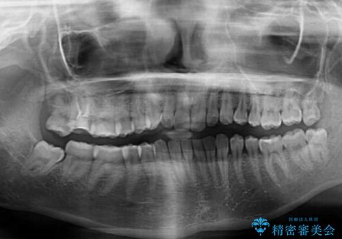 治療途中の奥歯と矯正治療の後戻り インビザライン・ライトによる矯正治療の治療前