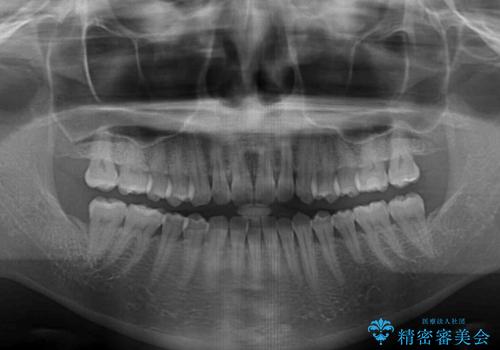 【モニター】前歯のデコボコをインビザラインで改善の治療前