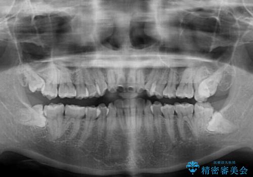 【モニター】口が閉じにくい 抜歯矯正で口元を引っ込めるの治療前