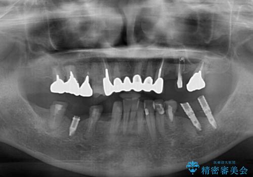 放置したインプラントとインビザライン 全顎リカバリー治療の治療前