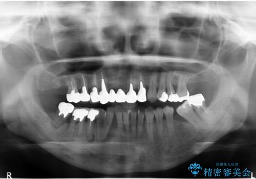 全体的な歯周病治療 包括治療の治療前