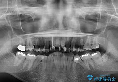 デコボコと深い咬み合わせ　ワイヤー装置での抜歯矯正の治療前