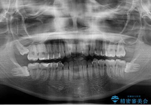 【モニター】短期間で終わりたい ワイヤー装置での非抜歯矯正の治療前