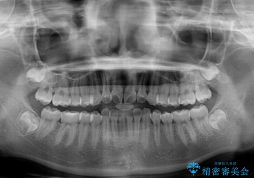 インビザラインは使える自信がない ワイヤー装置にて矯正治療の治療前