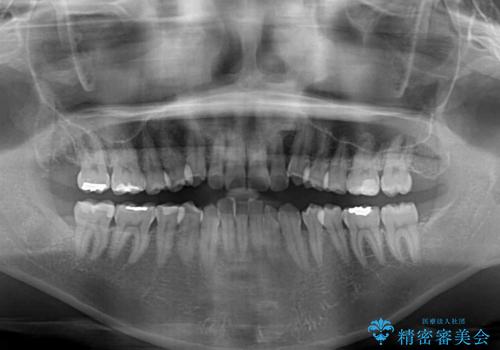 【モニター】カリエール・ディスタライザーを併用した八重歯のインビザライン矯正 の治療前