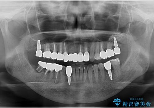 全体的な歯周病治療　包括治療の治療後