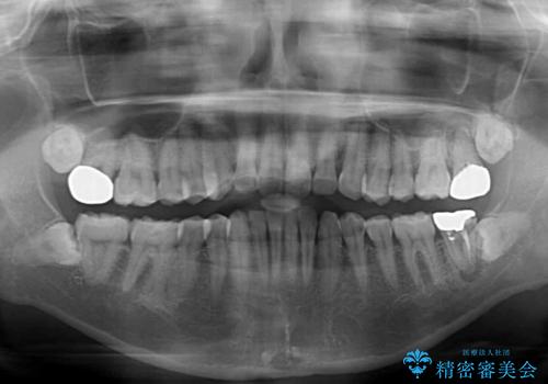 むし歯だらけの前歯をオールセラミッククラウンできれいにの治療前