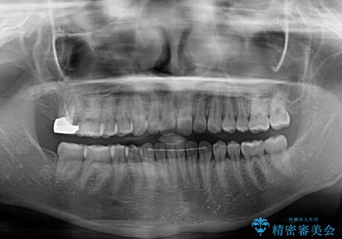 【モニター】下顎前歯のデコボコをインビザラインできれいにの治療後