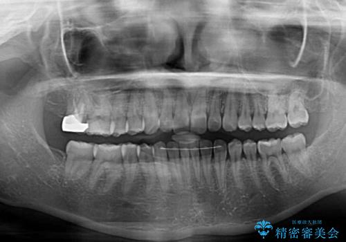 治療途中の奥歯と矯正治療の後戻り インビザライン・ライトによる矯正治療の治療後