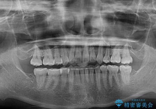 【モニター】口が閉じにくい 抜歯矯正で口元を引っ込めるの治療後