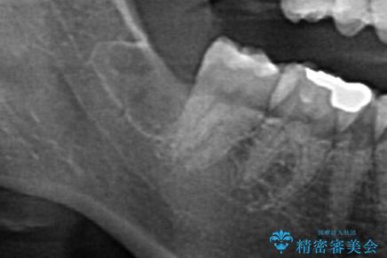 親知らず抜歯の治療後
