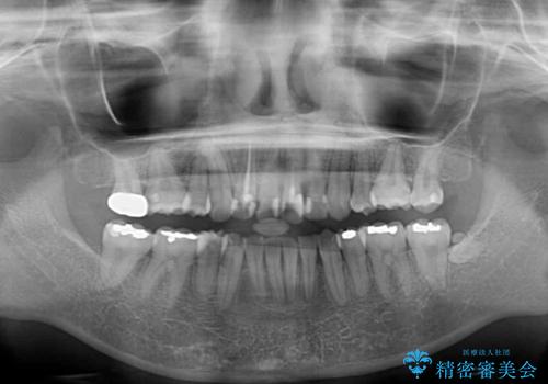 デコボコと深い咬み合わせ ワイヤー装置での抜歯矯正の治療後