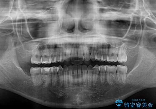 【モニター】短期間で終わりたい ワイヤー装置での非抜歯矯正の治療後