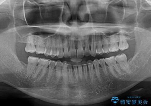 【モニター】前歯のデコボコをインビザラインで改善の治療後