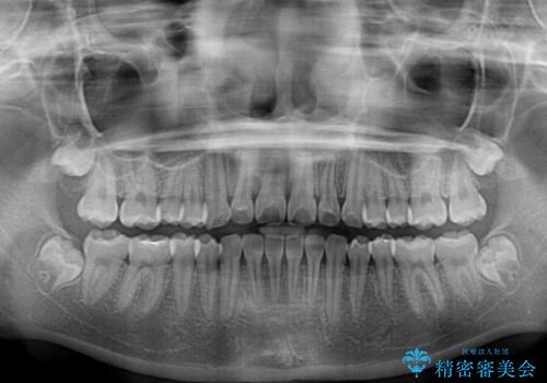 インビザラインは使える自信がない ワイヤー装置にて矯正治療の治療後
