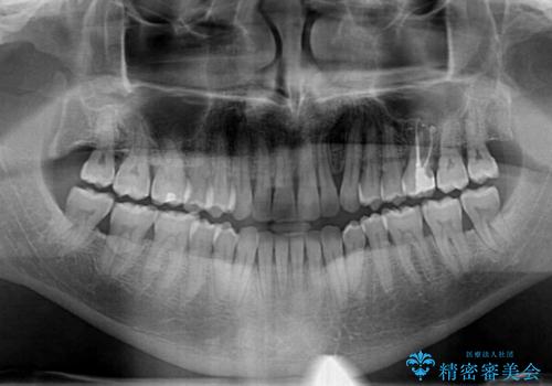 前歯でものを噛みきりたい 目立たない装置でのワイヤー矯正の治療後